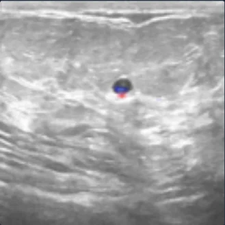 Ultrasound containing a benign tumor with relevance