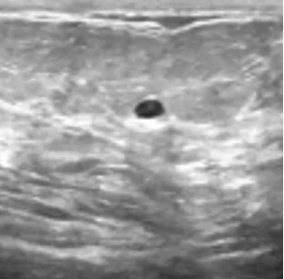 Ultrasound image containing a benign tumor