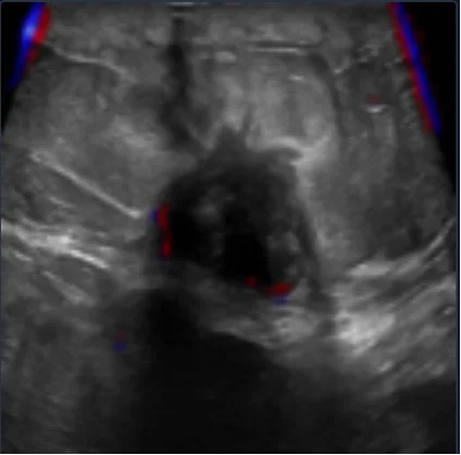 Ultrasound containing a malignant tumor with relevance