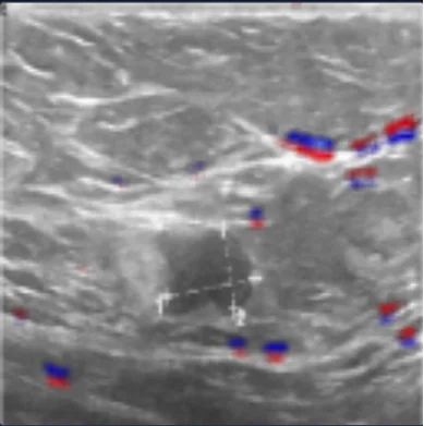 Relevance for ultrasound image containing a malignant tumor with text removed